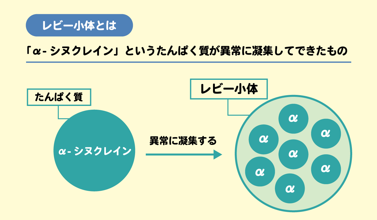 パーキンソン病の進行過程で黒質の神経細胞内に認められるレビー小体とα-シヌクレインが凝集されるイメージ図
