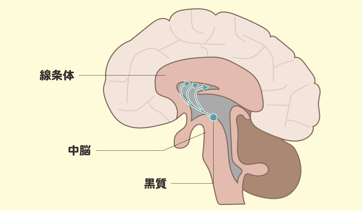 パーキンソン病を発症した方の脳内で起こっていることのイメージ