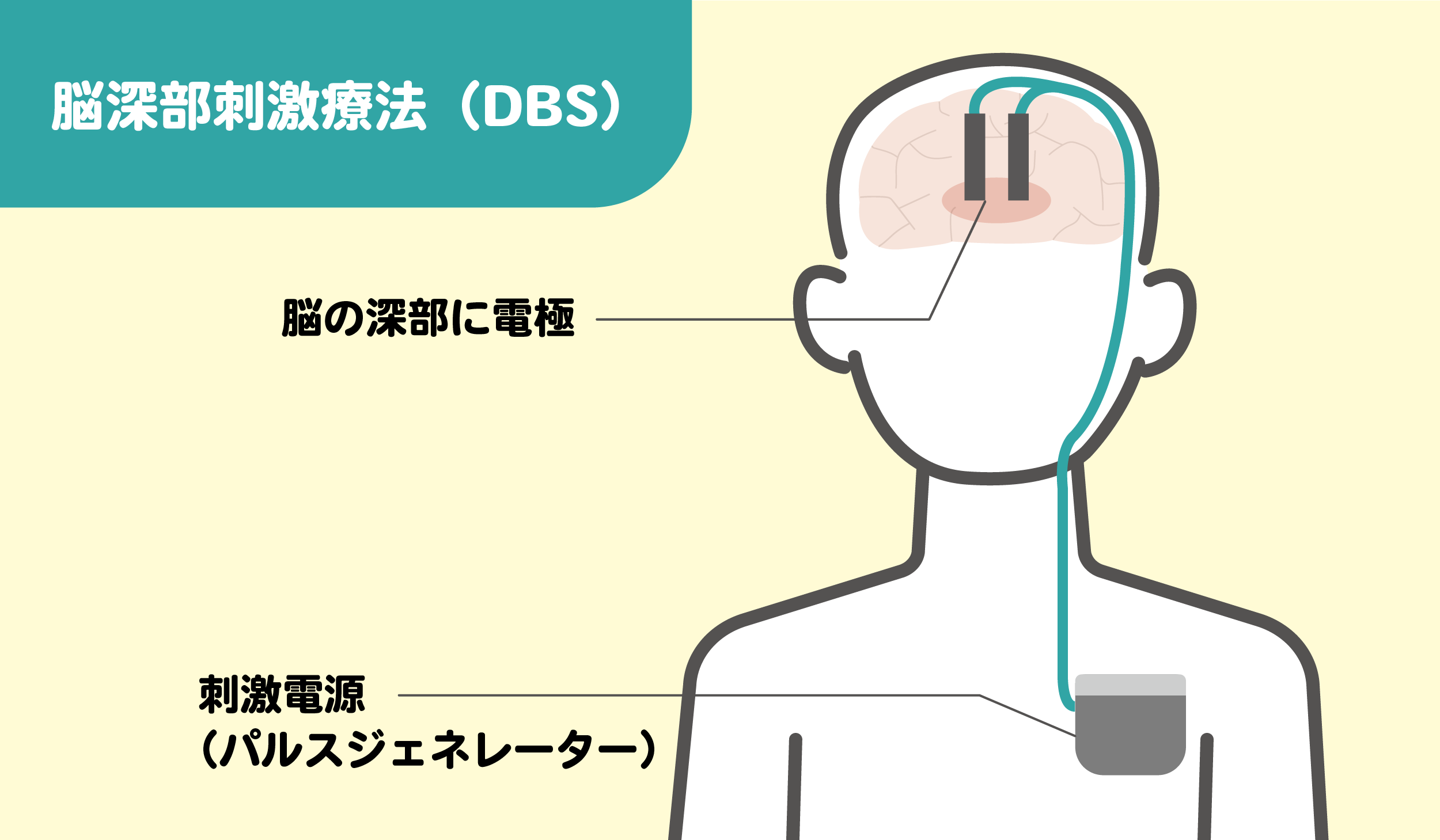 脳深部刺激療法（DBS）のしくみをわかりやすくイラストで図解