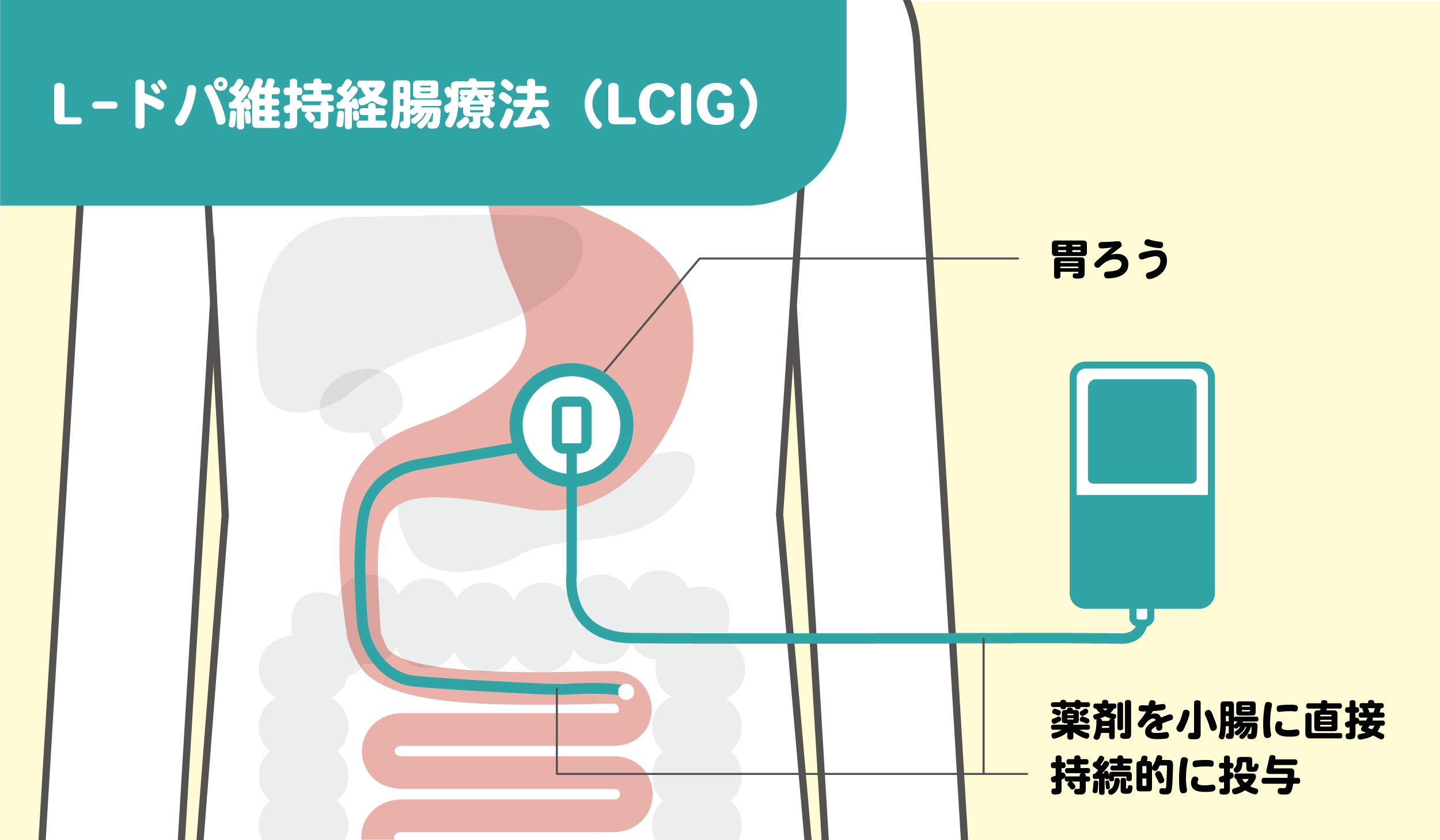 L-ドパ維持経腸療法（LCIG）のしくみをわかりやすくイラストで図解
