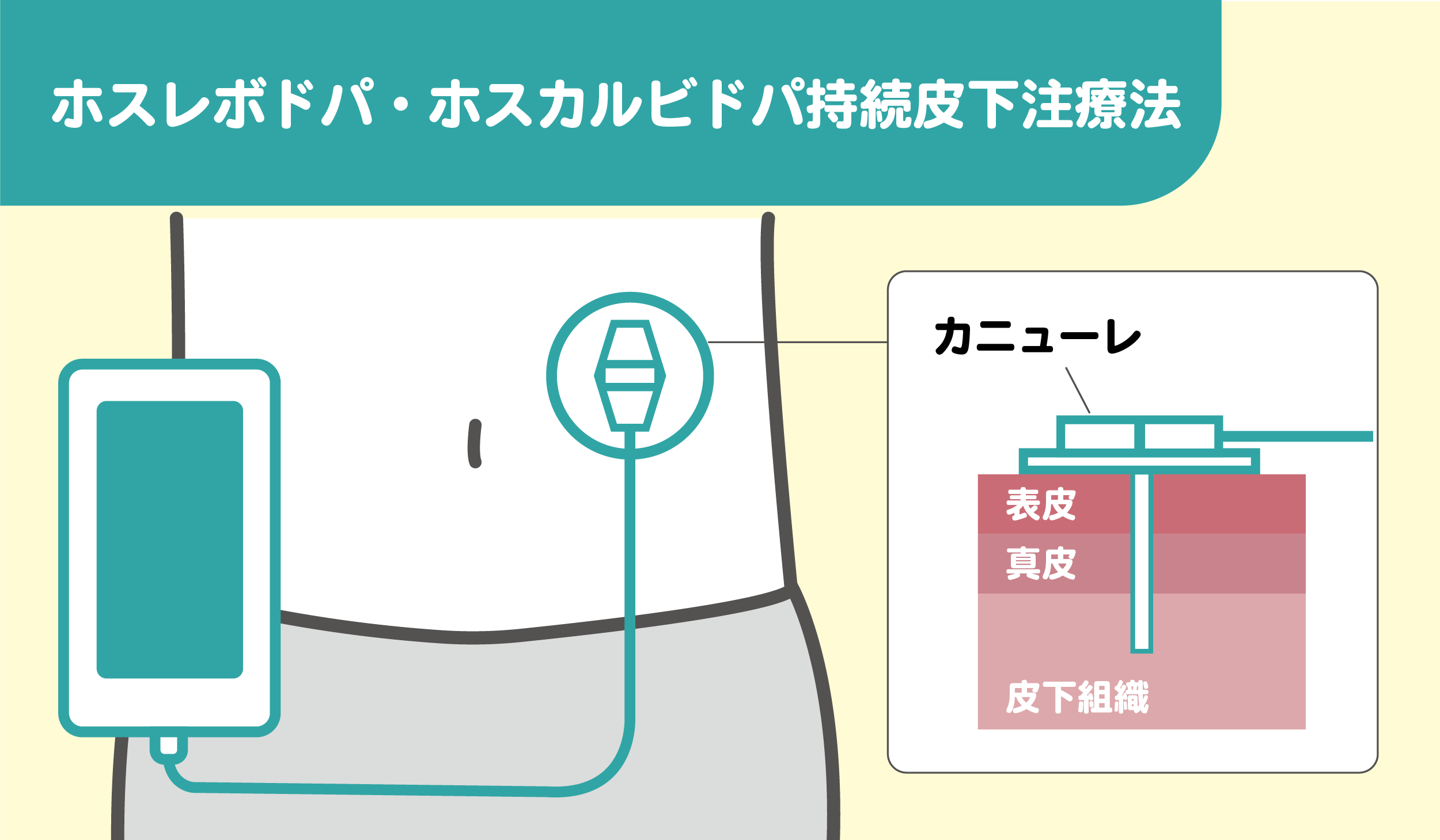 ホスレボドパ・ホスカルビドパ持続皮下注療法のしくみをわかりやすくイラストで図解