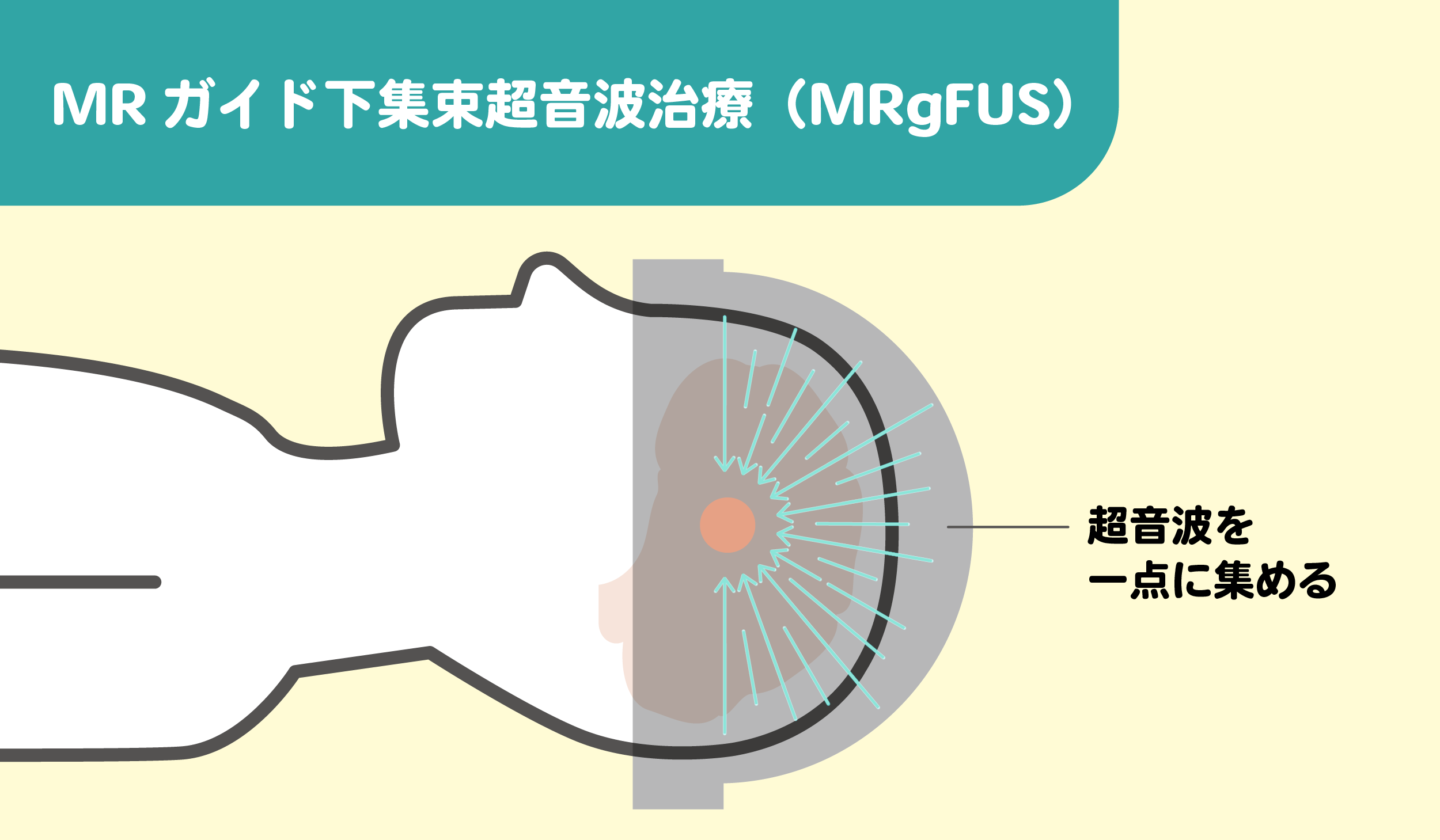 MRガイド下集束超音波治療（MRgFUS）のしくみをわかりやすくイラストで図解